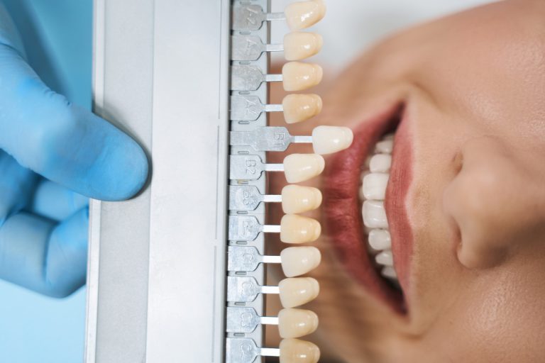 כמה עולה השתלת שיניים בזאלית