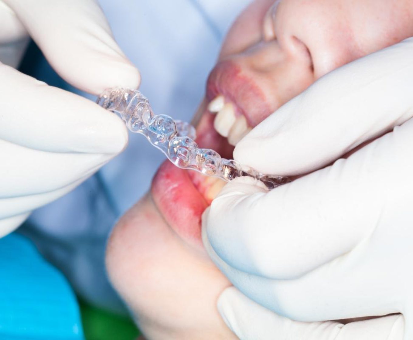 עקירת שיניים כירורגית